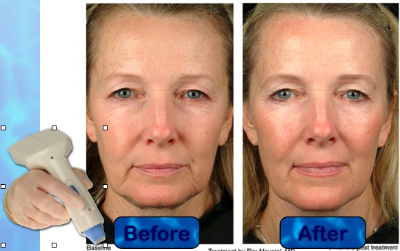 body thermage before after photos body thermage before after photos